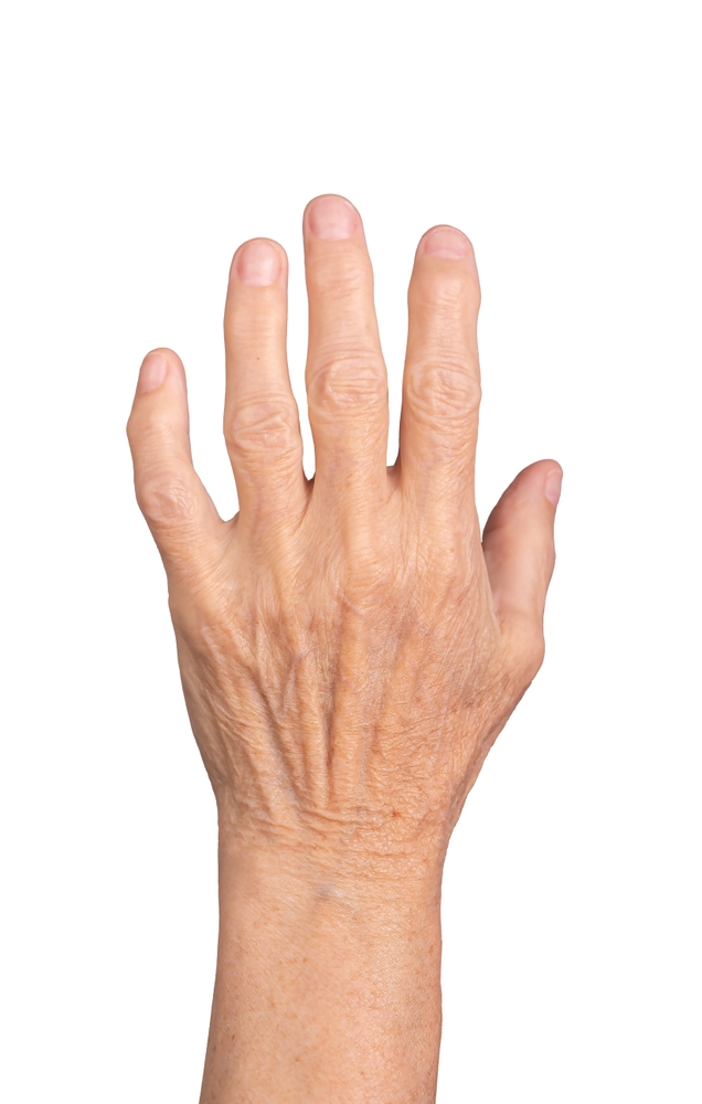 Vampire Facial treatment