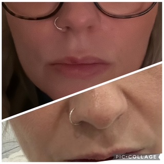 Nose to Mouth Filler