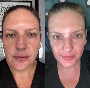 Tox, Cheek & Lip Filler