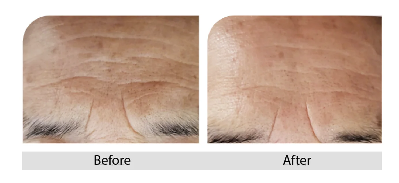 Mintt Real Fit Lifting Facial