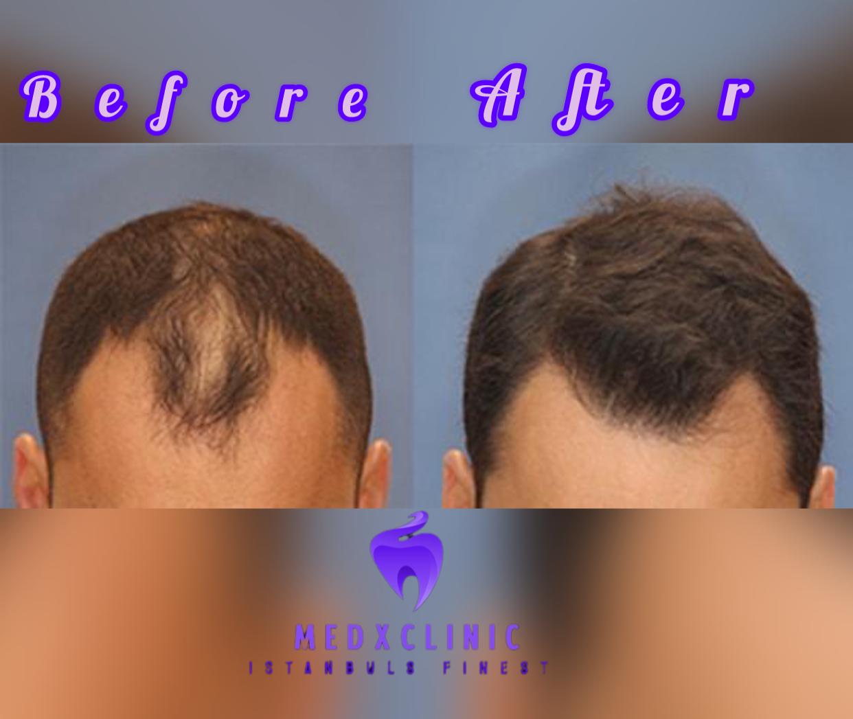 Hair transplant and hollywood smile's image