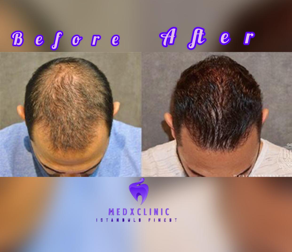 Hair transplant and hollywood smile's image