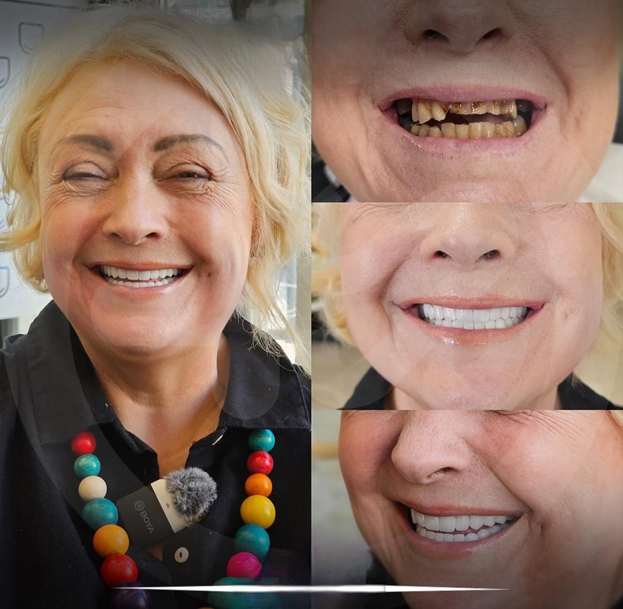 Hair transplant and hollywood smile's image