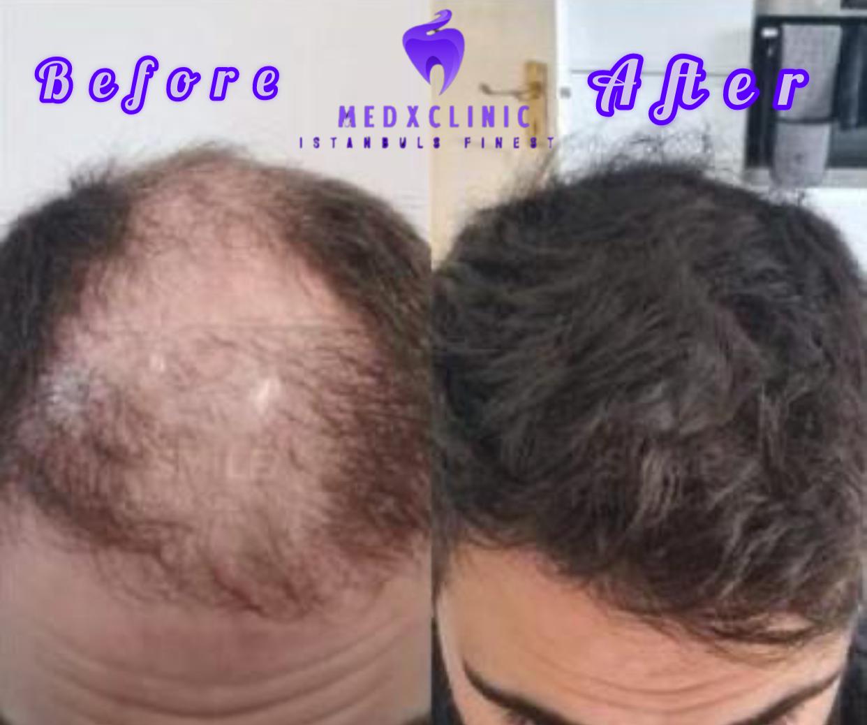 Hair transplant and hollywood smile's image