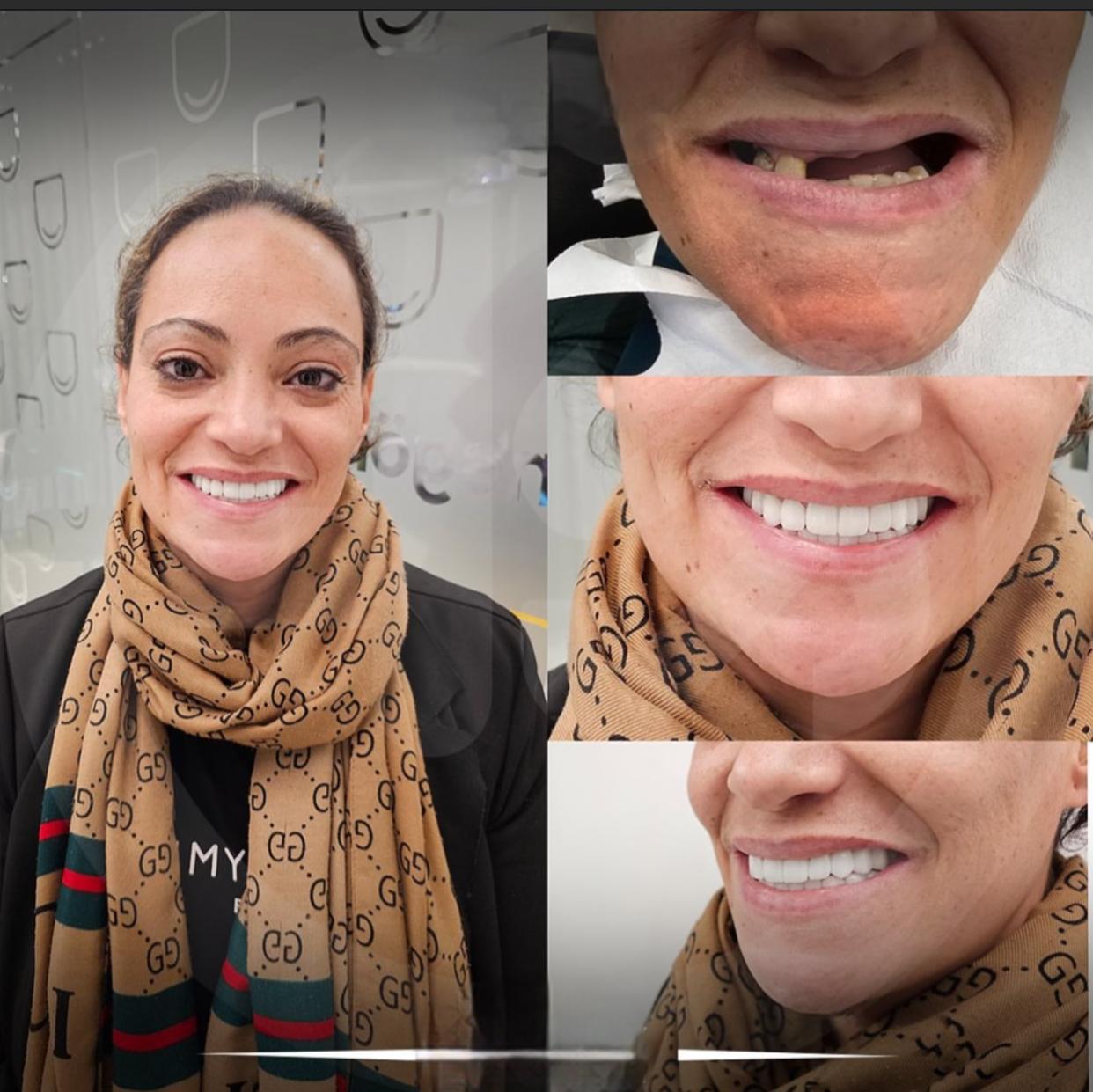Hair transplant and hollywood smile's image