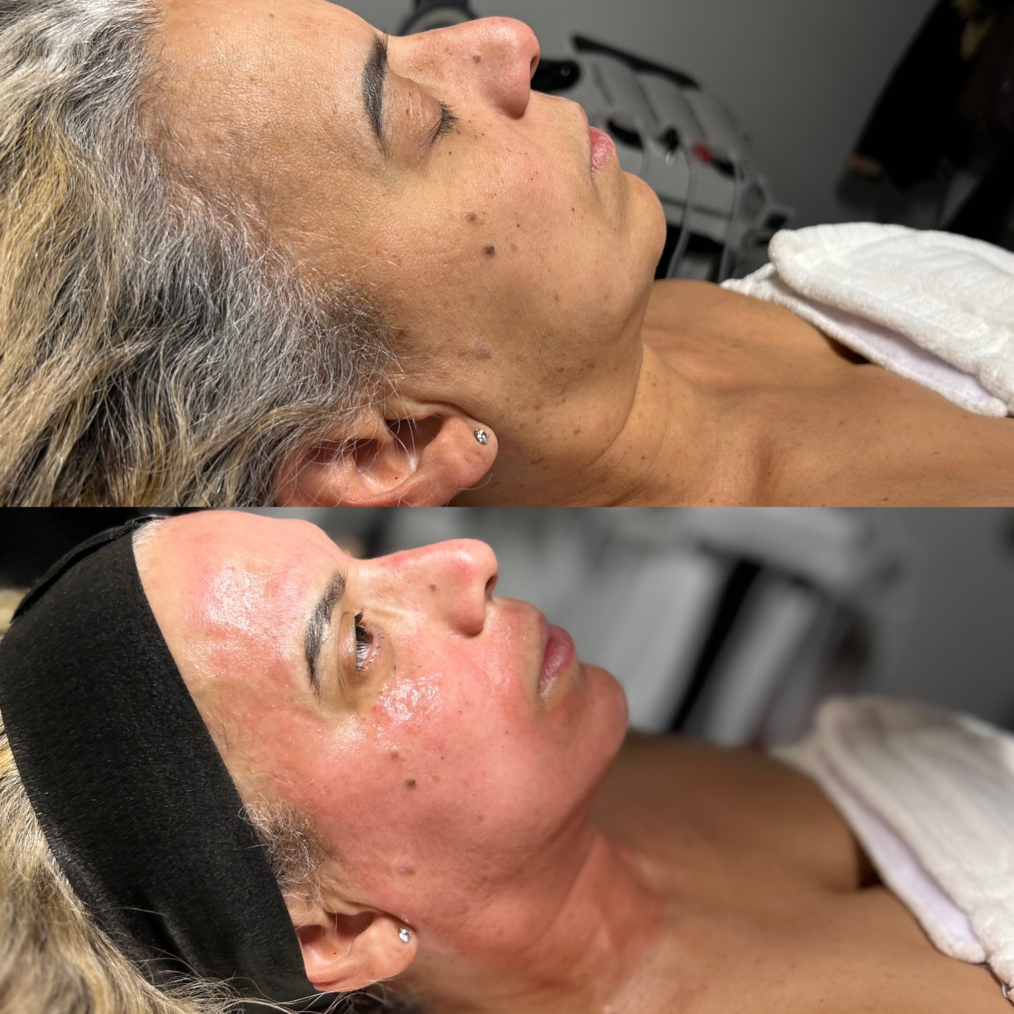 Before and after salmon sperm facial