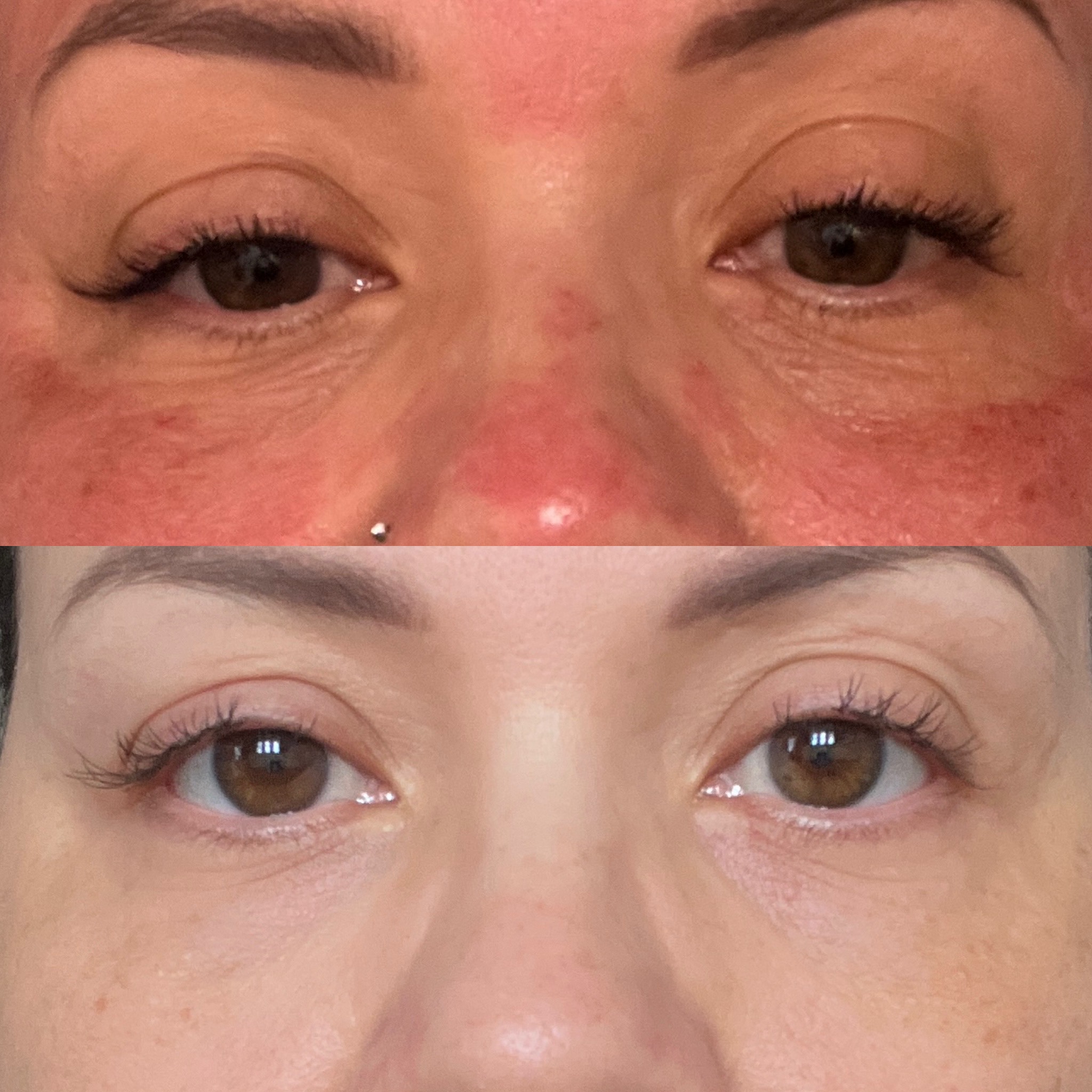 PDRN before and after 