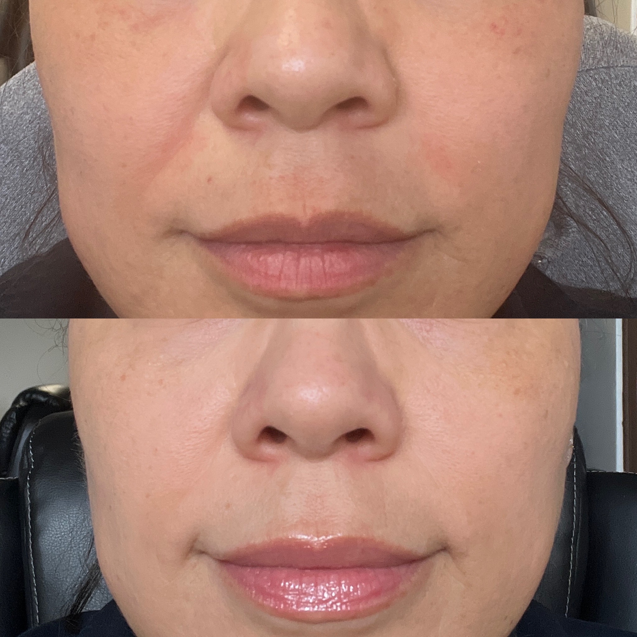 Microneedling with salmon sperm before and after