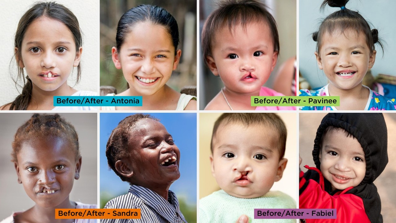Operation Smile