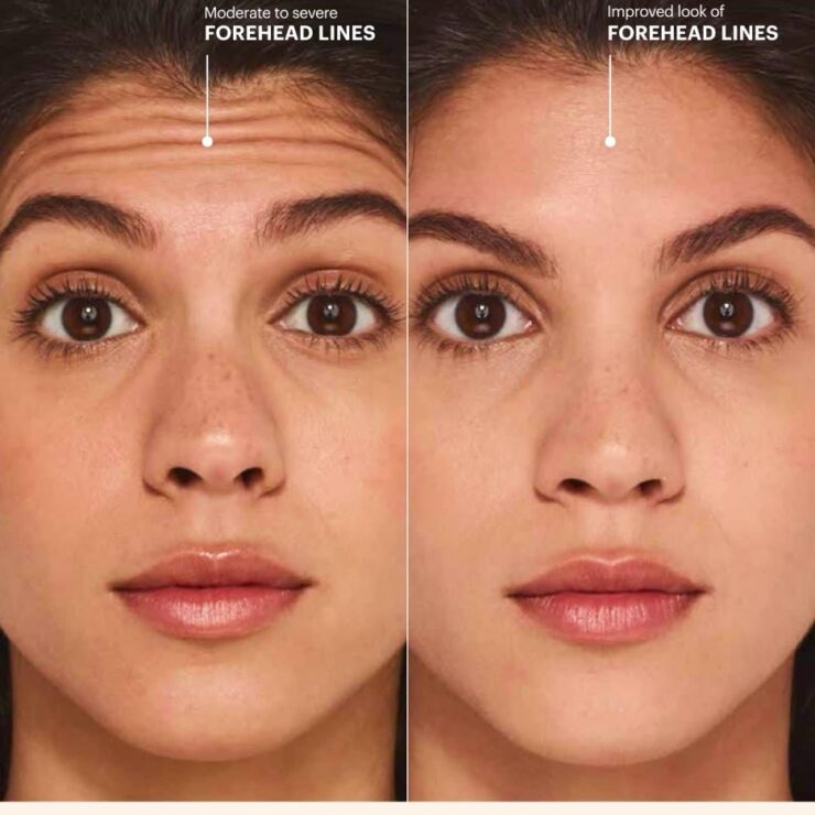 Botox