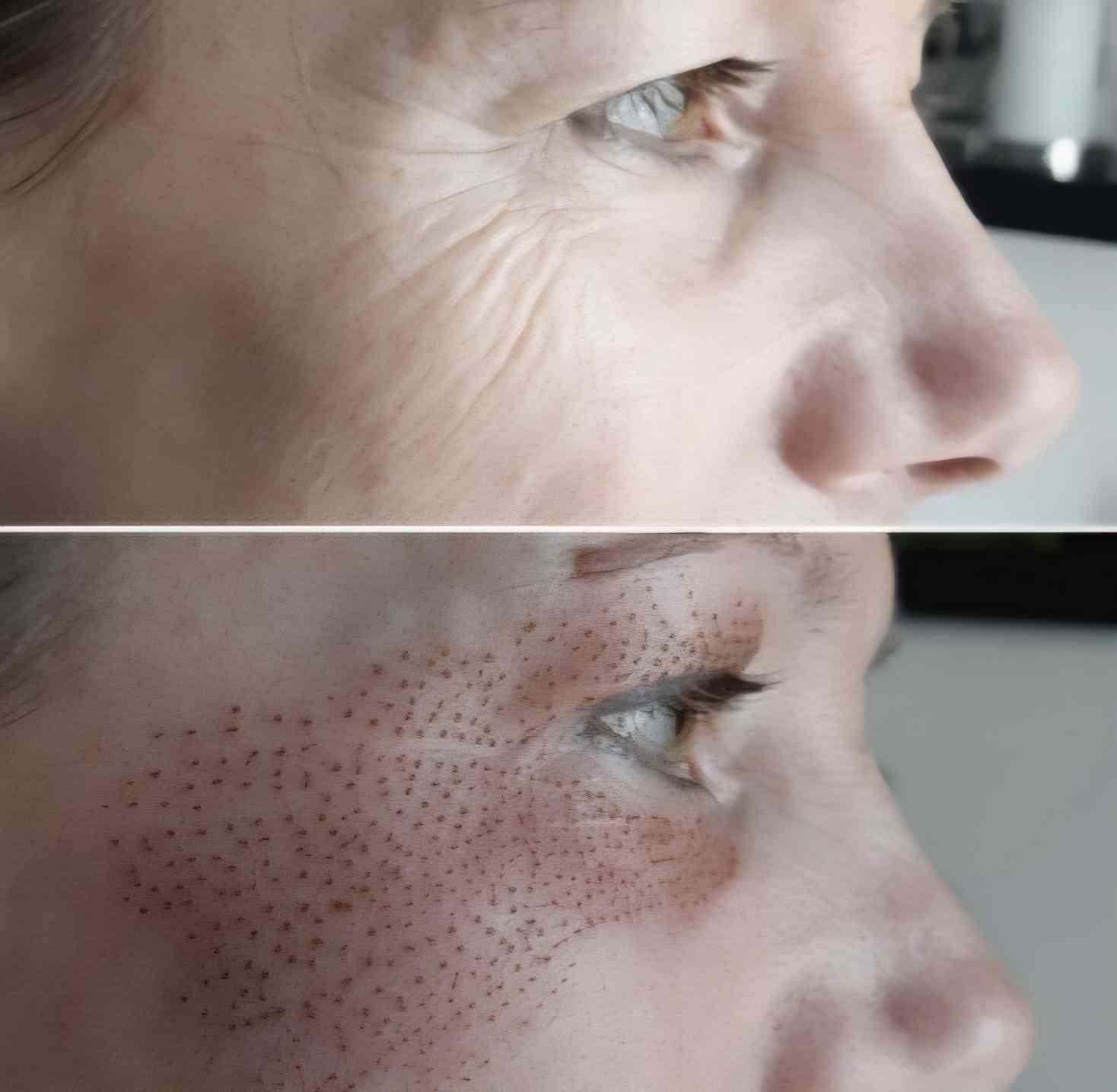 Hautverjüngung mit Plasma's image