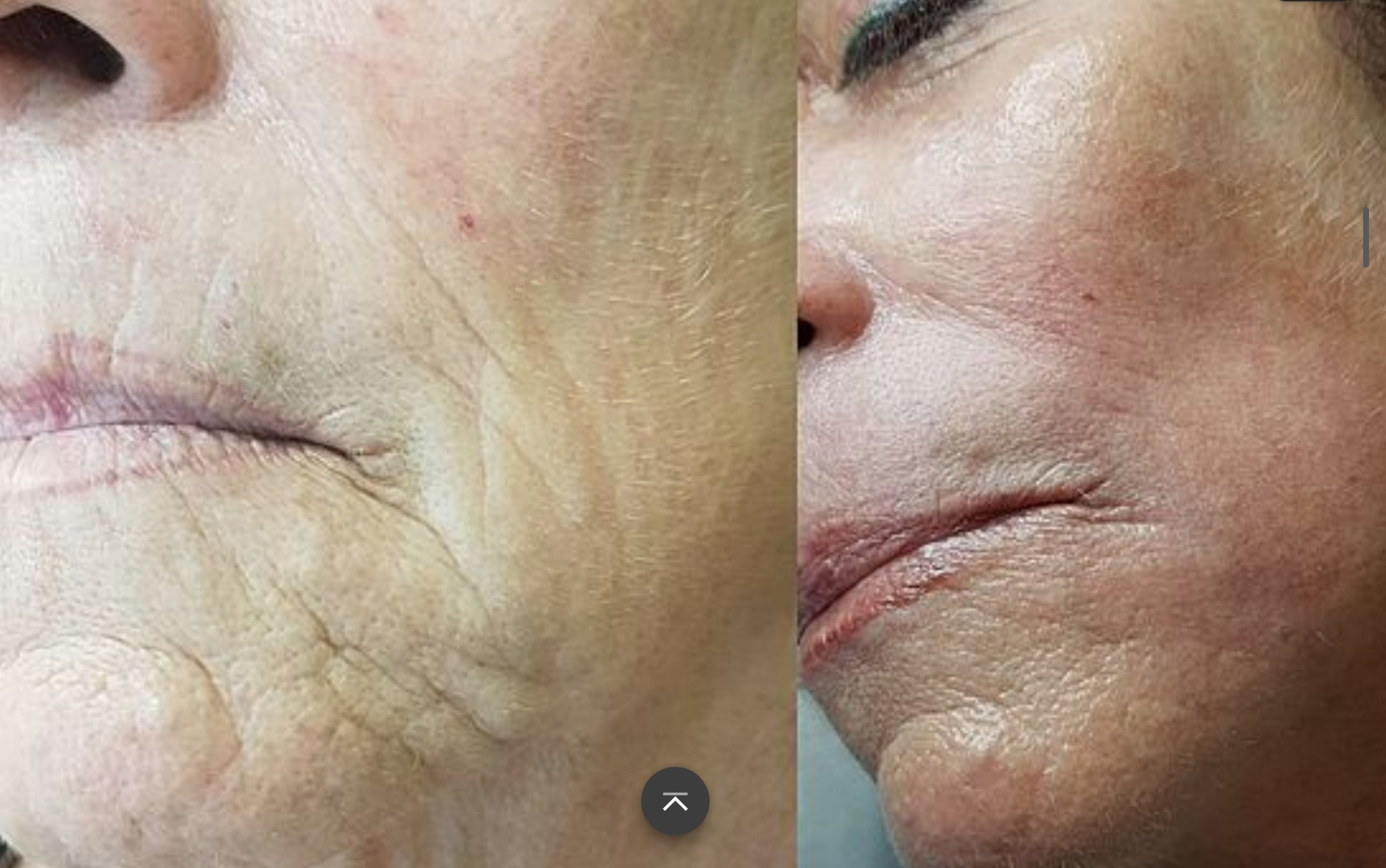 Hautverjüngung mit Plasma's image