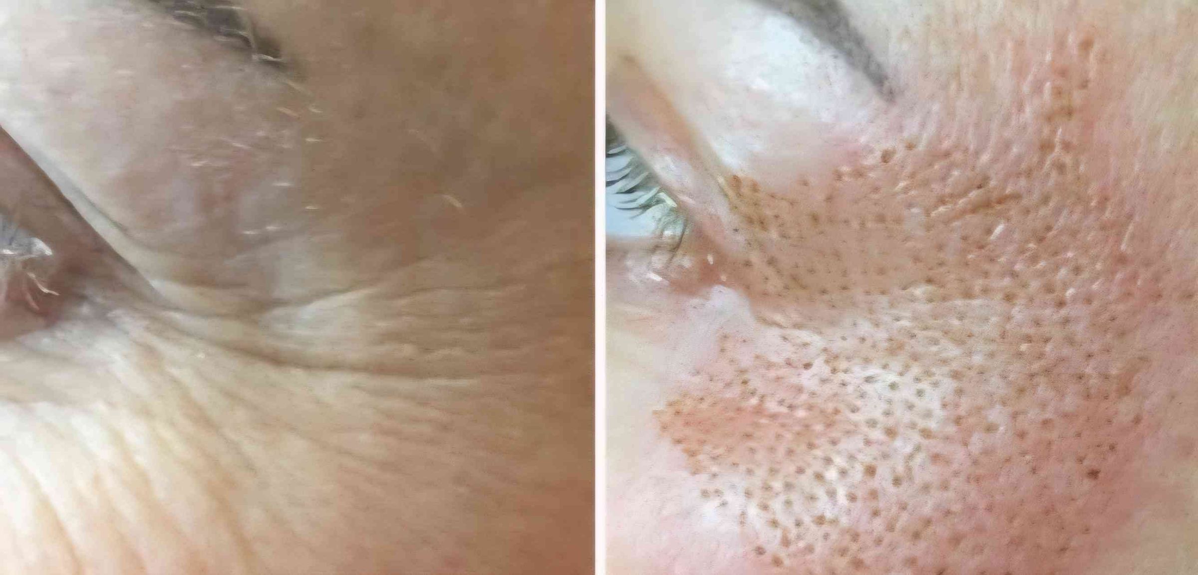 Hautverjüngung mit Plasma's image