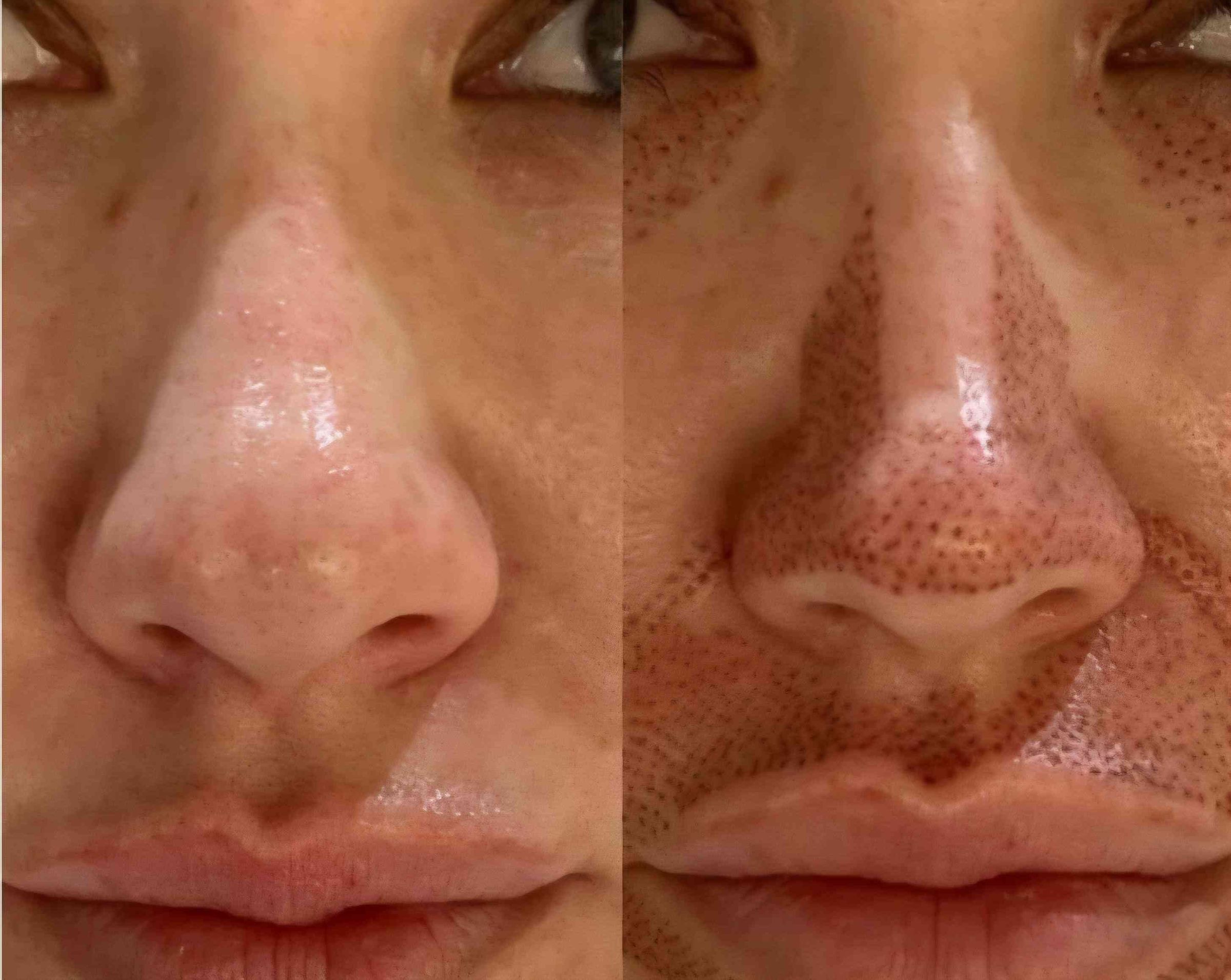 Hautverjüngung mit Plasma's image