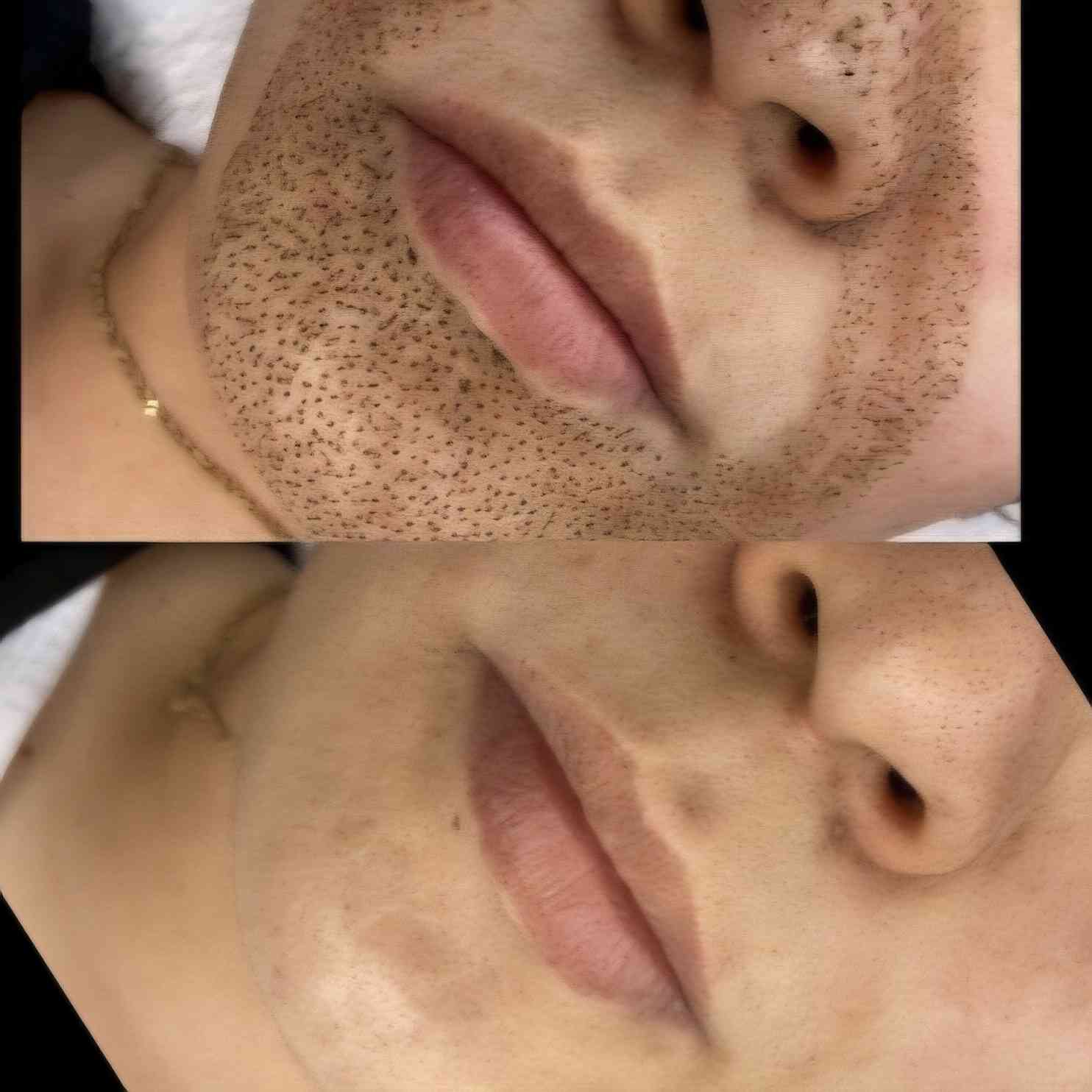 Hautverjüngung mit Plasma's image