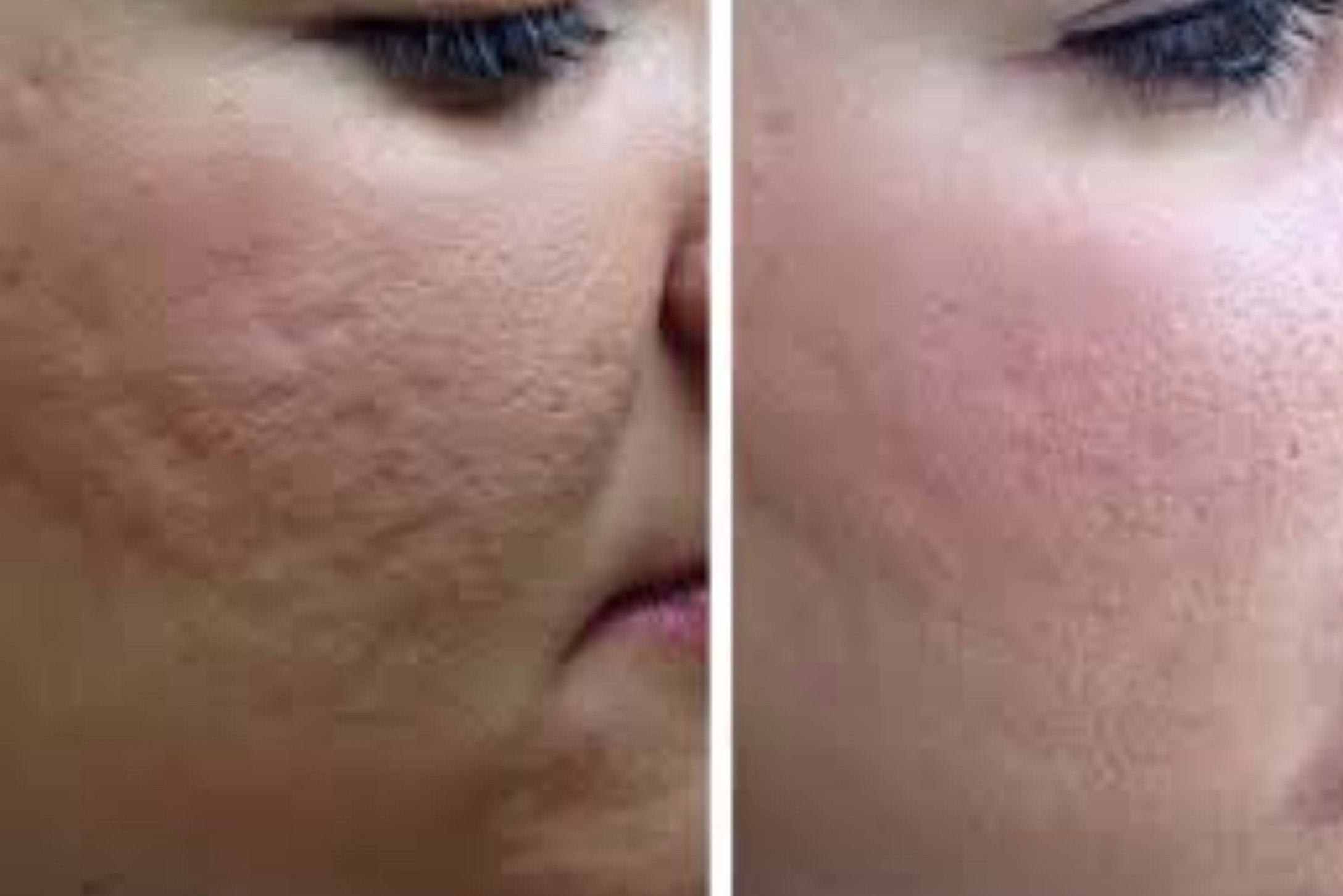 Hautverjüngung mit Plasma's image