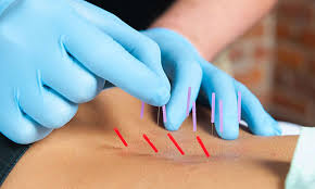 Precision Tension Relief, LLC's image