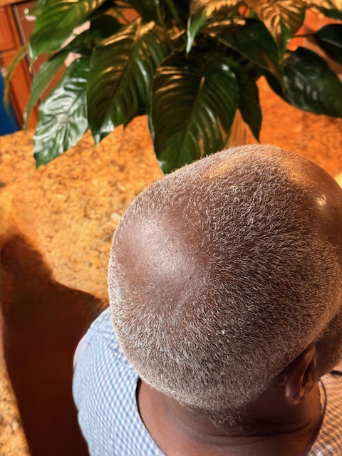 My father struggles with male pattern baldness- Start date, July 4, 2025. 