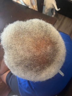 October 9, 2025 - CLEARLY, 1DL Oils can reverse baldness, period!!