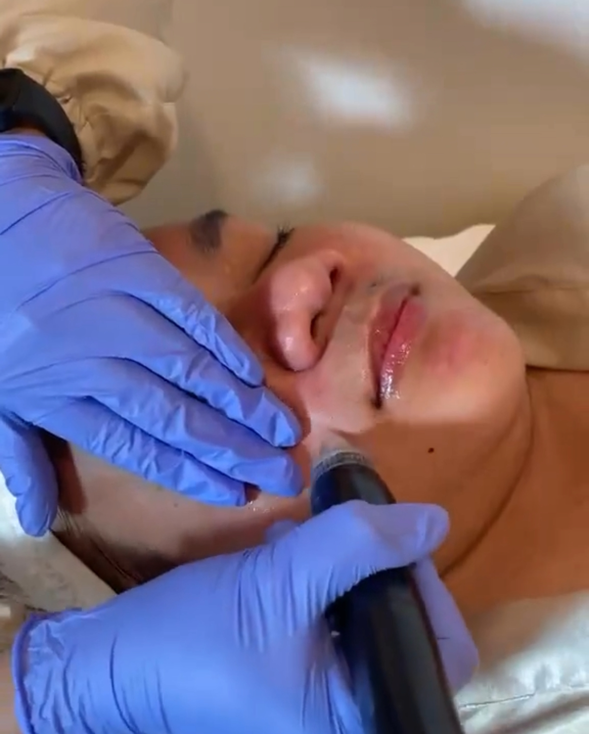 Hydrafacial