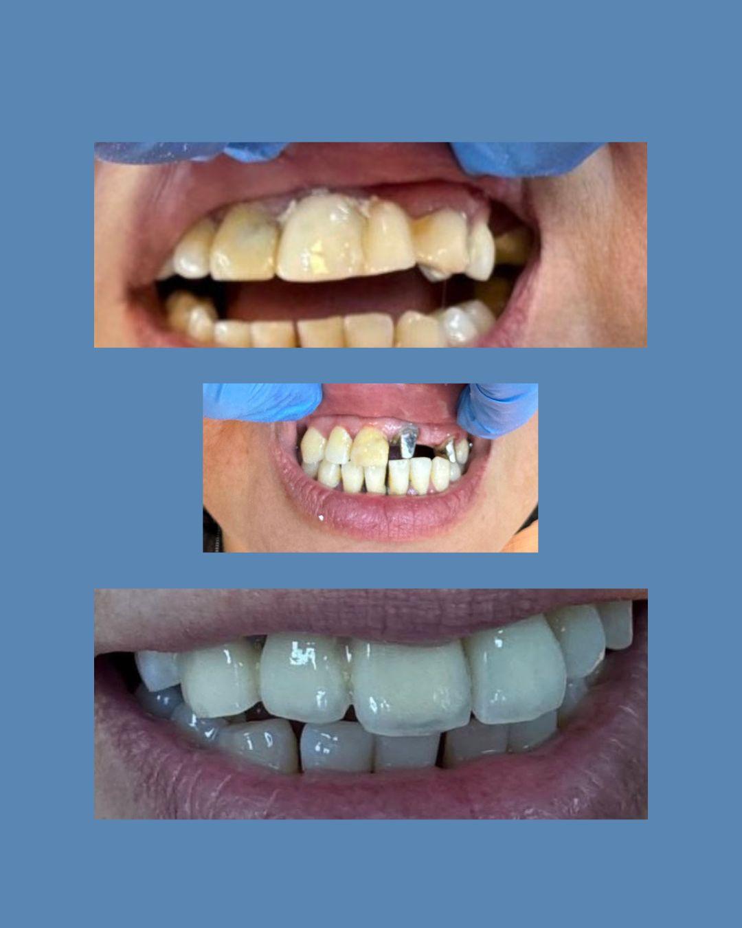 Coronas y Puente Fijo