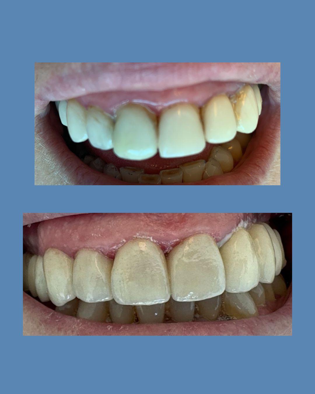 Carillas implante puente fijo