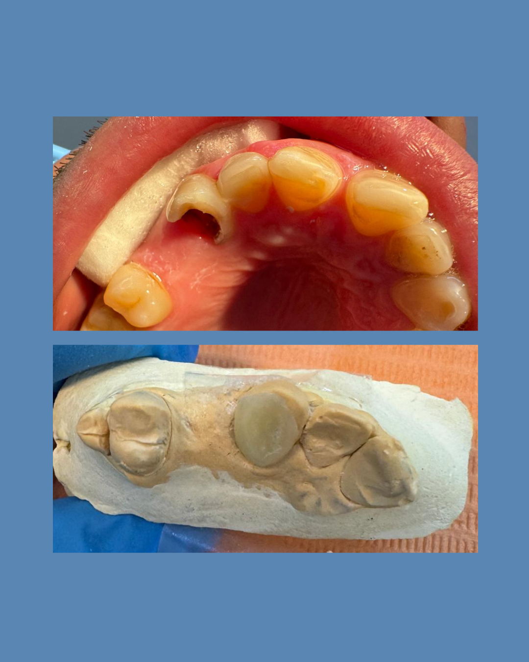 Incrustacion de resina