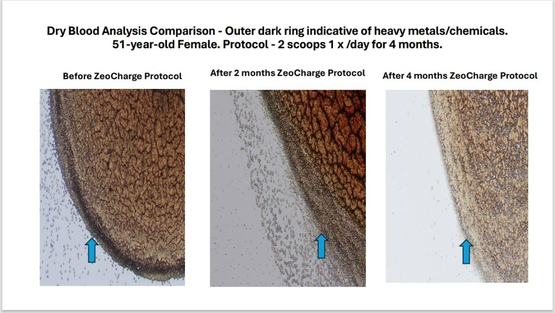 Before ZeoCharge 2 and 4 Month Comparison of Heavy Metals in the blood